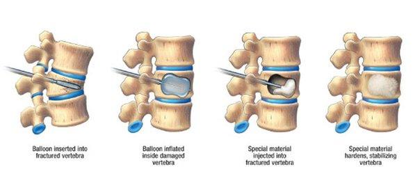 Minimally Invasive Kyphoplasty Procedure