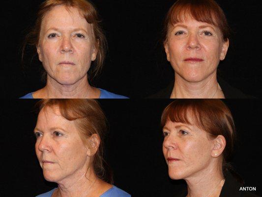 59 year old woman, 5'4″, 145 lbs., Facelift, Lower Eyelids, Lateral Brow Lift, Lasers, Newport Beach, CA