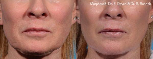 Morpheus8 Microneedling stimulates collagen production while resurfacing and tightening skin.