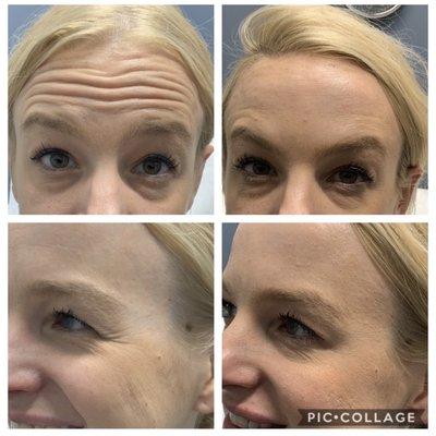 Botox treatment in forehead & around eyes/crows feet (she also had area between the eyebrows treated). Beautiful softening of dynamic lines.