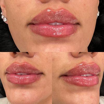 Lip filler treatment