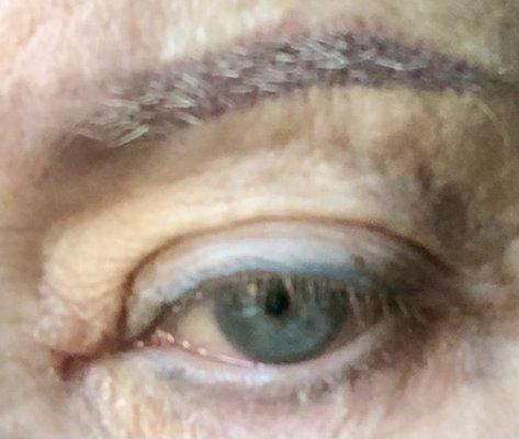 Incorrect botox injection caused drooping eye lid.