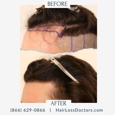 Male Before / After Sample from The Hair Loss Doctors By Robert J. Dorin with Surgical Headquarters in Garden City, NY.