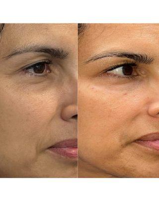 Filler and Botox can create a natural but youthful facial boost!