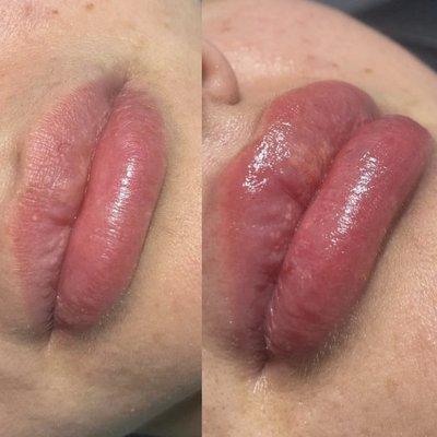 Needle free lip filler touch up 0.5 ml