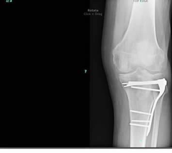 Post op result and American Fidelity denies there is torn or repaired cartilage