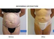 Liposuction