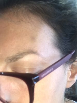 Bruising from botox