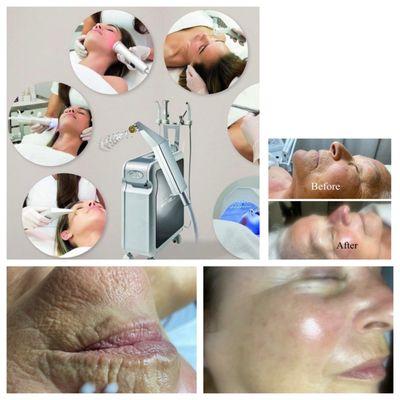 Oxyjet facial.