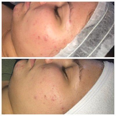 Results from one acne peel treatment. 2 weeks between photos.