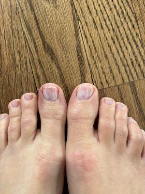 Ouch and ick! Pedicure result