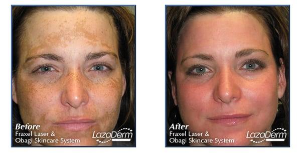 Fraxel laser/Obagi skincare system