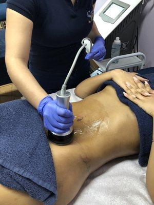 Post operatorios#lymphatic massages# drenaje linfático# post liposuction massages