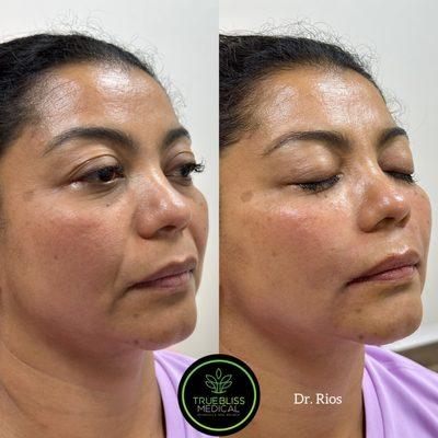 Dermal filler Cheeks and Nasolabial Fold