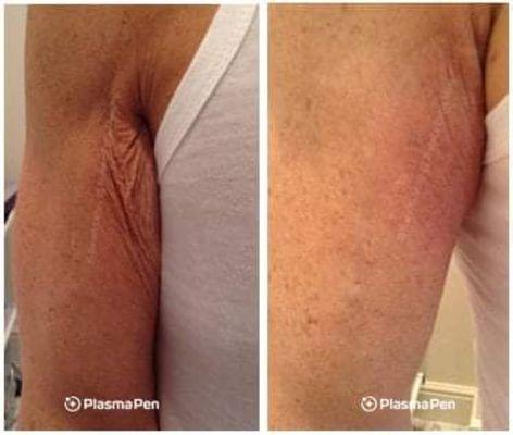 Fibroblast Plasma treatment on inner arm