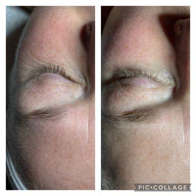 Before and after eye treatment