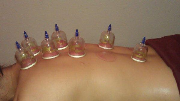 massage cupping