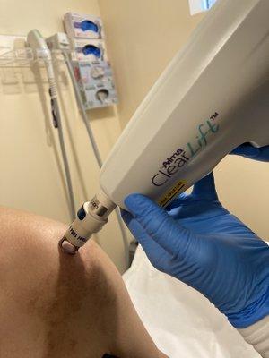 Laser Scar Revision with Harmony XL Pro Clearlift at Everest Medspa. Ideal Scar Treatment.