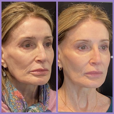 From top to bottom full facial rejuvenation.  Soft, natural and refreshed. #botox #pdothreads