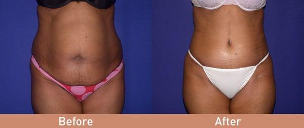 Tummy Tuck