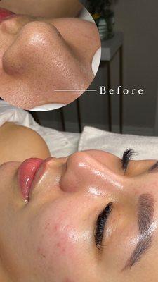 Microdermabrasion facial