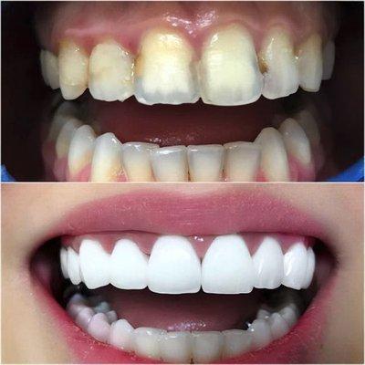 Before and After at NÜVA Smile | Bergenfield, NJ