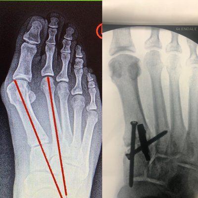 Bunion Correction