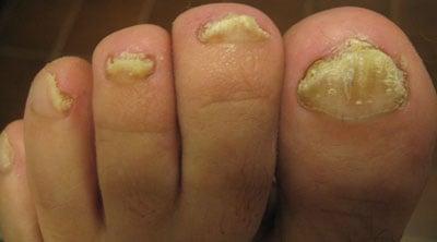 Fungal Nail