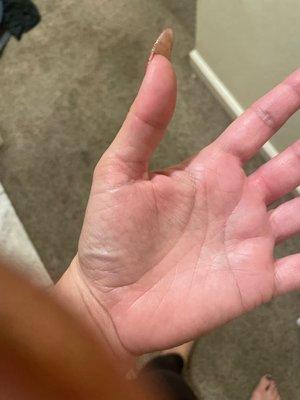 My burnt hand