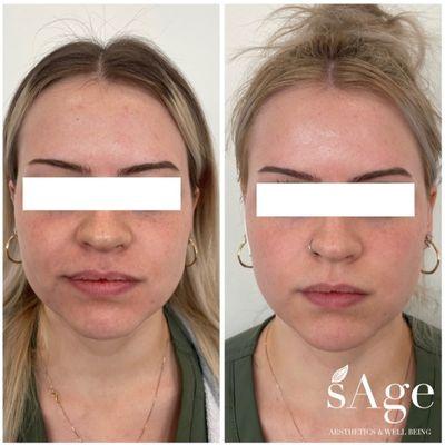 Reduced pigmentation
 Brighter skin
 Improved texture
 Prejuvenation

Before & after for one of our favorite lasers - the Sciton MOXI