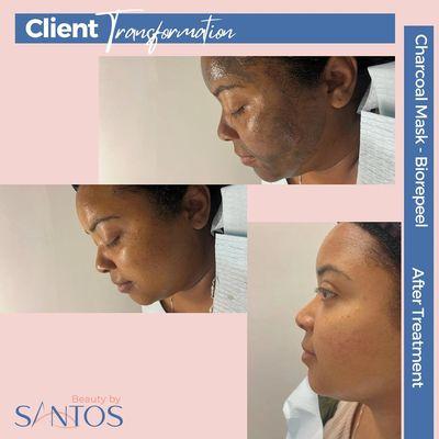 Our exclusive acne and hyperpigmentation solution for a radiant complexion. 

Book now for a glowing skin year-round.