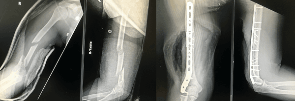 Segmental humeral shaft fracture  before and after surgical fixation with restoration of anatomy