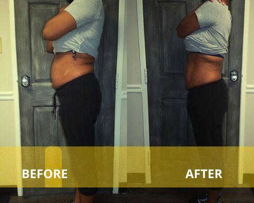 Before and after lipo Cavitation treatment