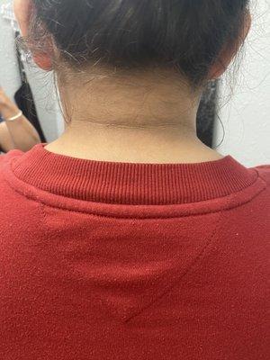 Back of the Neck; Skin Lightening Treatment 
Before and after