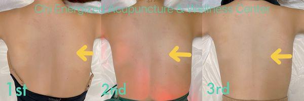 Results in treating scoliosis in 3 sessions.