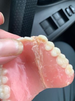 Broken denture Mortenson refused to fix after breaking into 3 pieces when only 14 months old! Dr. Allen had horrible chair side manner.