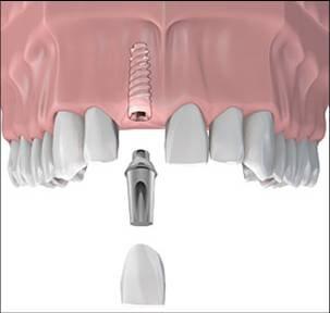 Dental Titanium Implant