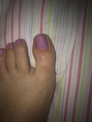 Got a pedicure and the next day I woke up with my big toe infected