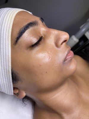 Dermaplaning Treatment