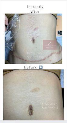 Tummy Tuck Scar