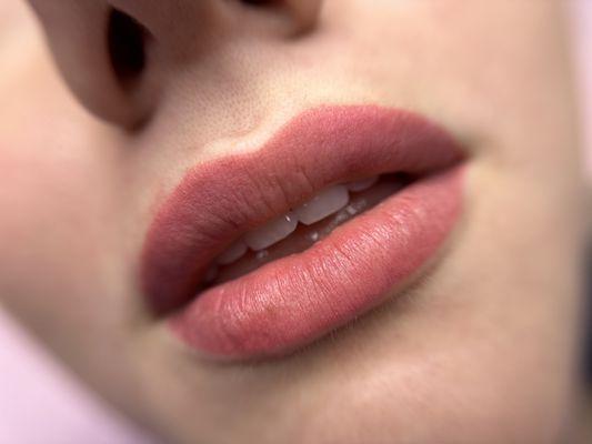 Lips immediately after procedure