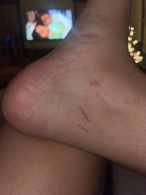 My ankle after a pedicure