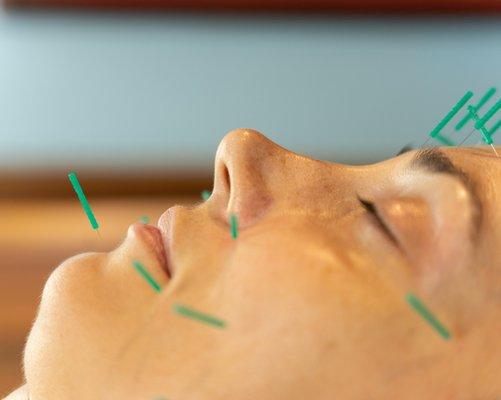 Acupuncture facial