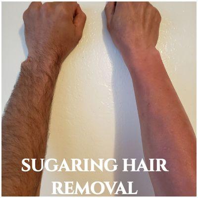 Sugaring hair removal arms