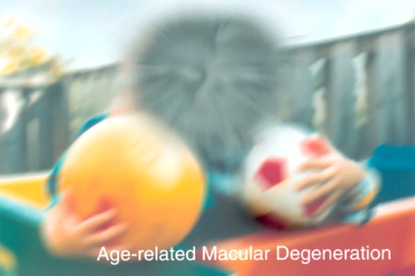 Macular problems cause blurred central vision. This can occur with many macular problems such as macular degeneration, diabet...