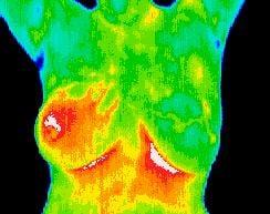 Inflammatory Breast Cancer- a mammogram would not catch this!