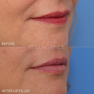 Lip filler