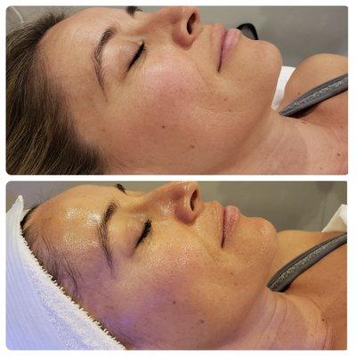 Deluxe HydraFacial