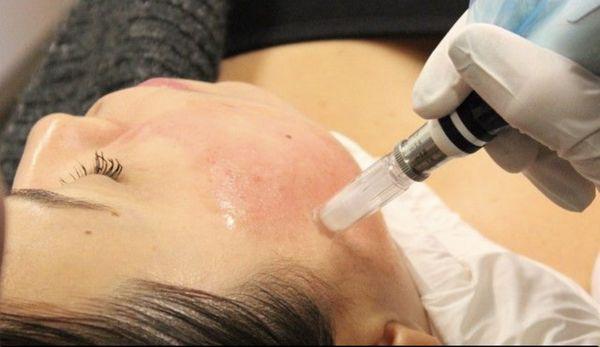 Collagen Induction Therapy/Microneedling is GREAT for acne scars and overall rejuvenation