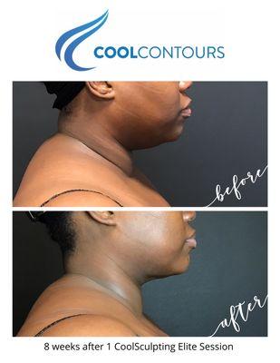 CoolSculpting Elite is FDA-cleared and eliminates up to 25% of fat with each session!